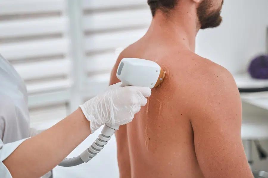 Laser-Behandlung bei The Gents Heilbronn
